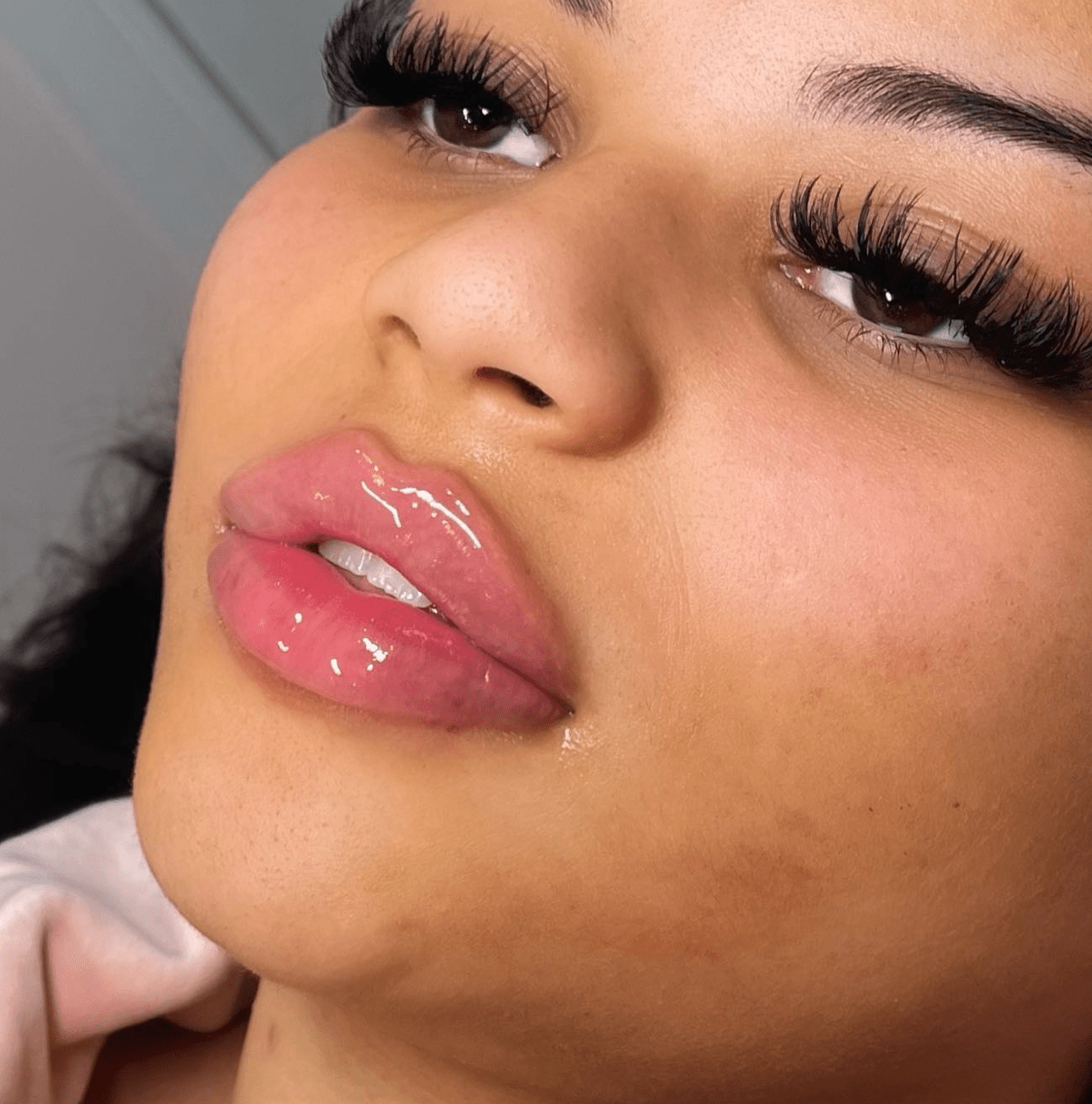 Lip filler swelling stages - Moon Aesthetics Academy