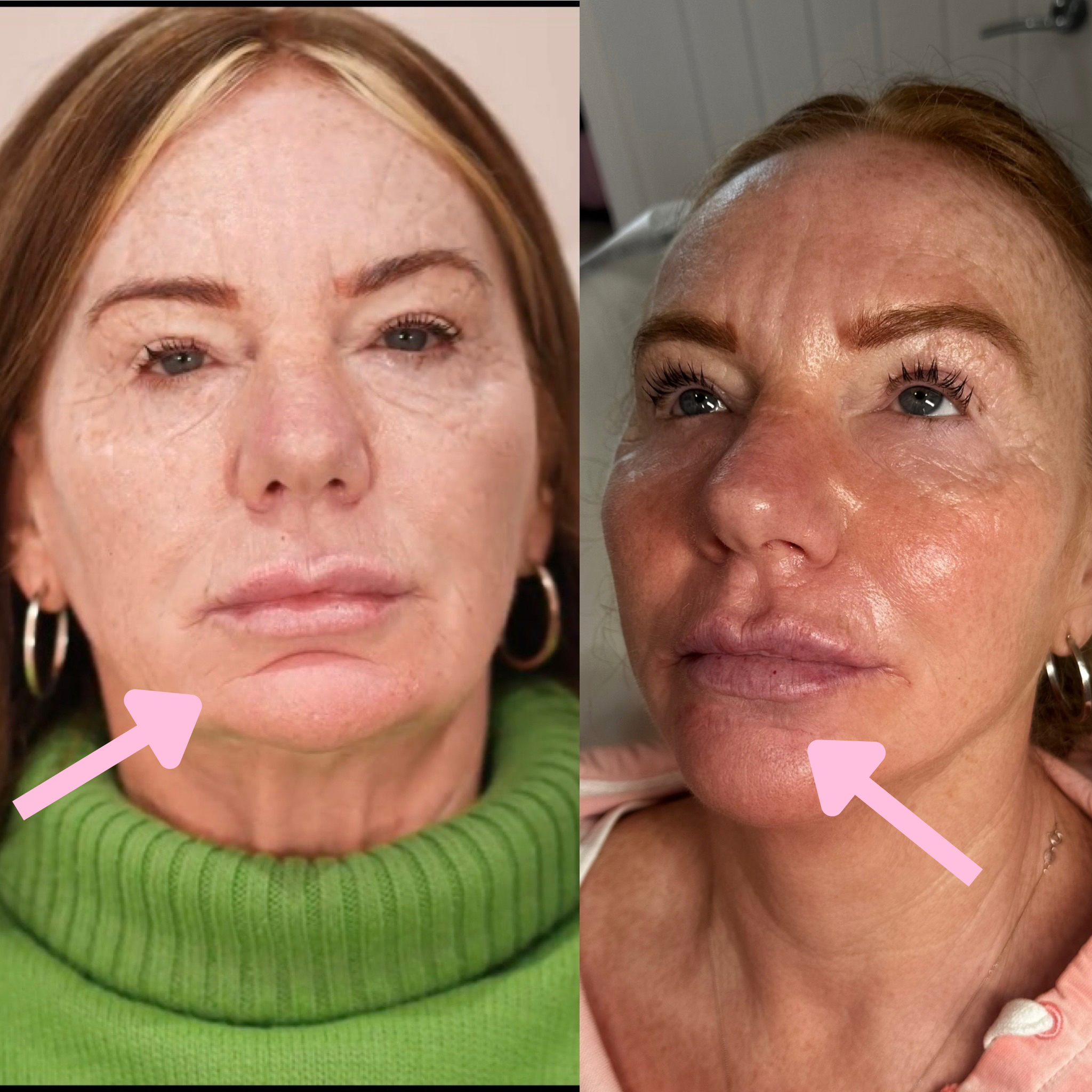 Chin Crease removal using dermal filler.