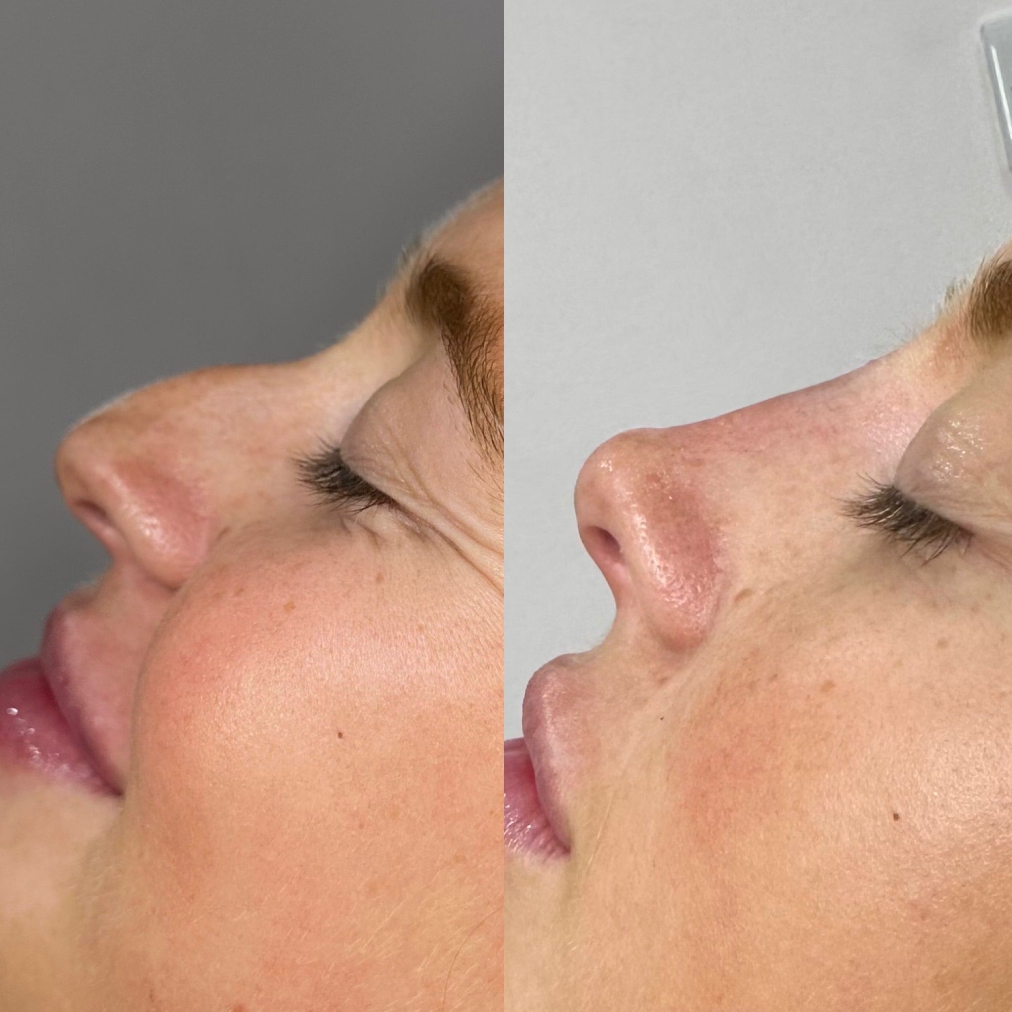 Non-surgical Rhinoplasty with Pixie Tip 2