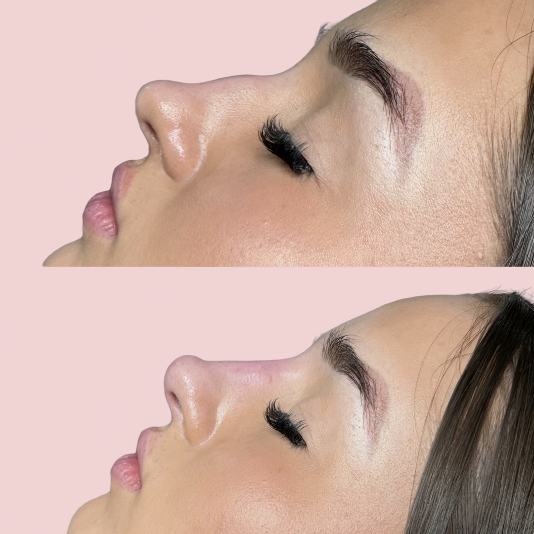 Non-surgical Rhinoplasty with Pixie Tip video 1